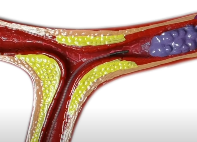 Milirobô pode se esgueirar dentro de artérias (Imagem: Reprodução/University of Hong Kong)