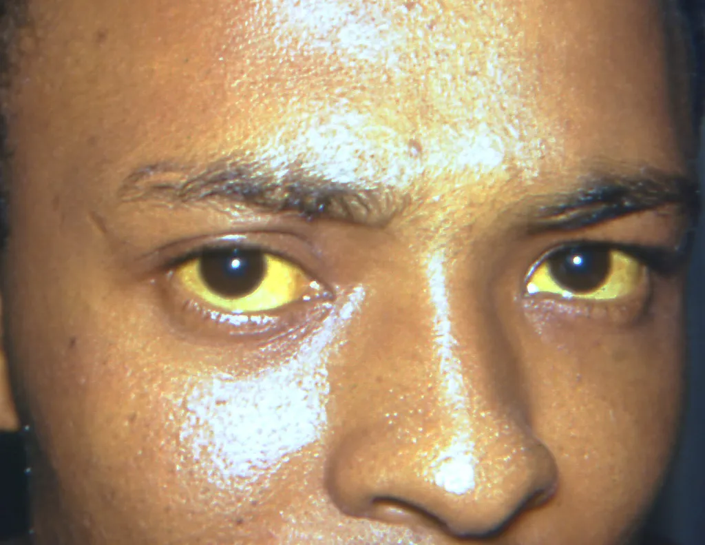 Olho amarelo é o principal sintoma da hepatite em crianças (Imagem: Reprodução/CDC/Thomas F. Sellers/Emory University)