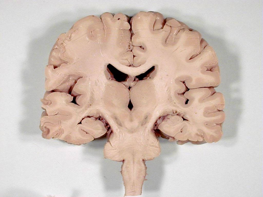 A massa branca é, como o nome diz, a parte mais esbranquiçada neste corte frontal do órgão — com Alzheimer e demência vascular, essa seção vai se perdendo, e agora sabemos como (Imagem: John A Beal/Louisiana State University)