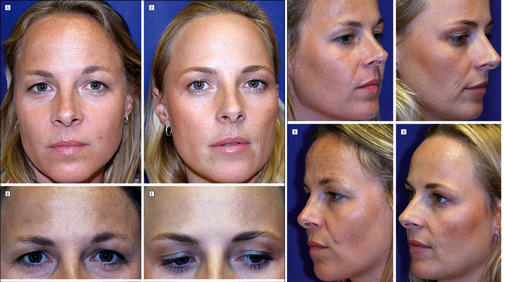 Experimento mostra o efeito do Botox o longo dos anos, a partir de gêmeos (Imagem: William Binder, 2006/Archives of Facial Plastic Surgery)