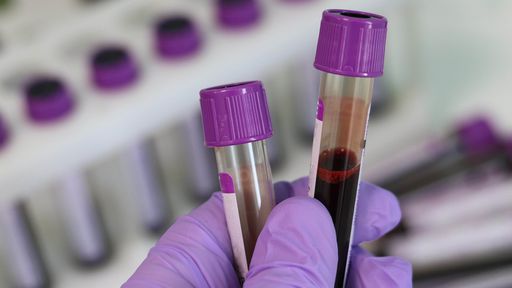 Novo exame de sangue brasileiro pode diagnosticar esquizofrenia e bipolaridade