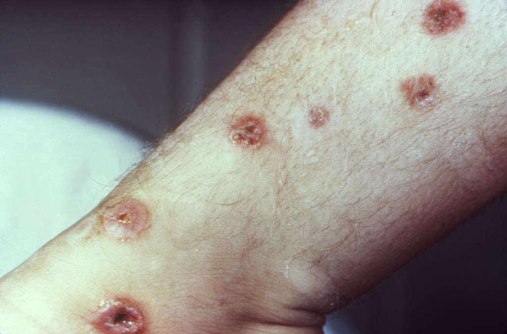 Na maioria dos casos, a Sífilis pode causar manifestações na pele, como feridas de diferentes graus (Imagem: Reprodução/ sífilis congênita)