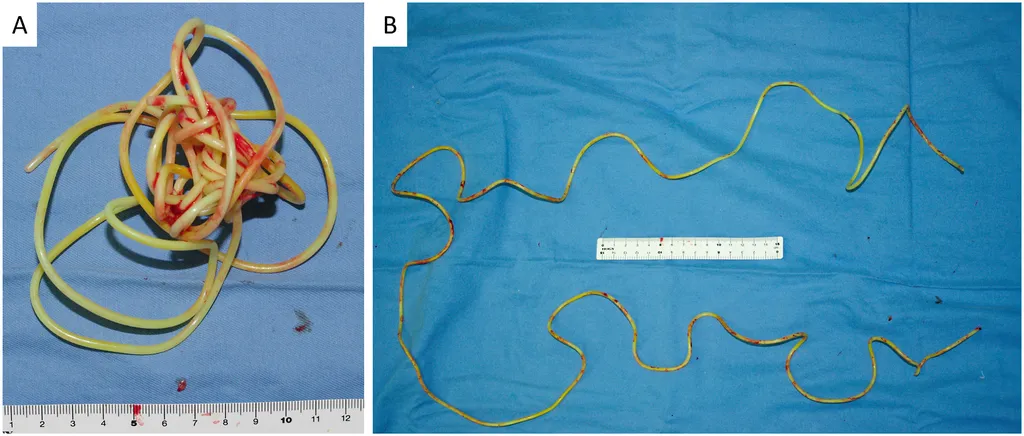 Corda de pular após a remoção da bexiga do paciente (Imagem: Yokoyama et al./Urology Case Reports)