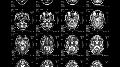 Nova técnica de estímulo cerebral pode ajudar pessoas com Parkinson