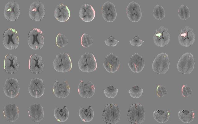 Cientistas criam software de IA que identifica hemorragia cerebral com rapidez