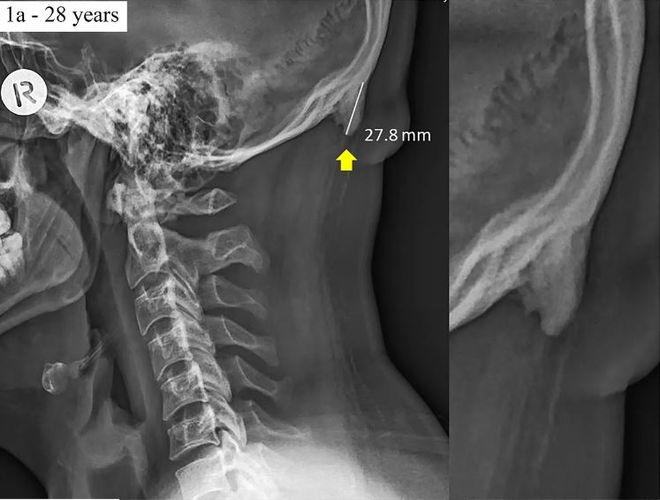 A EEOP é uma protuberância óssea que cresce na parte traseira do crânio, próximo ao local onde ele se encontra com a espinha vertebral (Imagem: Scientific Reports)