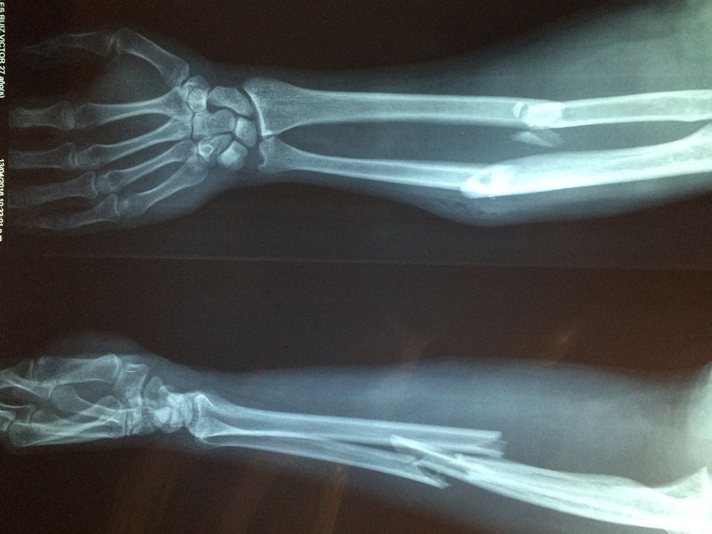Ossos quebrados são lesões perenes para médicos legistas (Imagem: Reprodução/Dr. Manuel González Reyes/Pixabay)