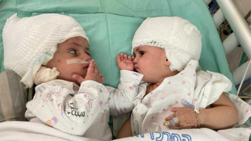 Em cirurgia raríssima, médicos separam gêmeas siamesas unidas pelo crânio