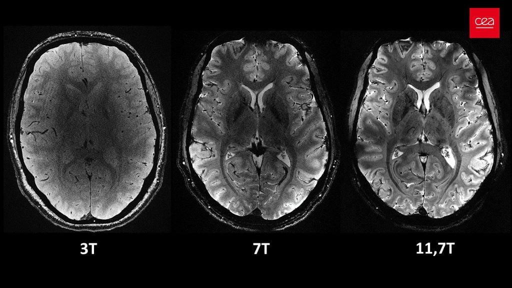 Ressonância mais potente do mundo faz imagens incríveis do cérebro