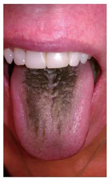 Pacientes com a síndrome da "língua peluda" parecem ter pelos dentro da boca (Imagem: Reprodução/Gurvits et al., 2014/World Journal of Gastroenterology)