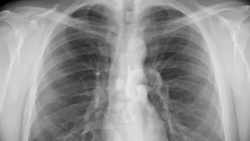 Algoritmo identifica pneumonia em pacientes de forma mais precisa que raio-x
