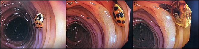 Homem vai fazer colonoscopia e descobre joaninha viva dentro do intestino; veja!