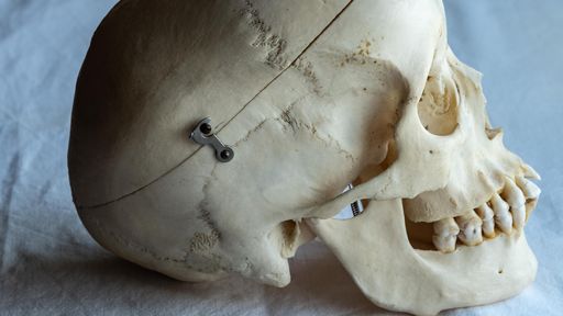 Trepanação: a medicina antiga tratava problemas mentais com um furo no crânio