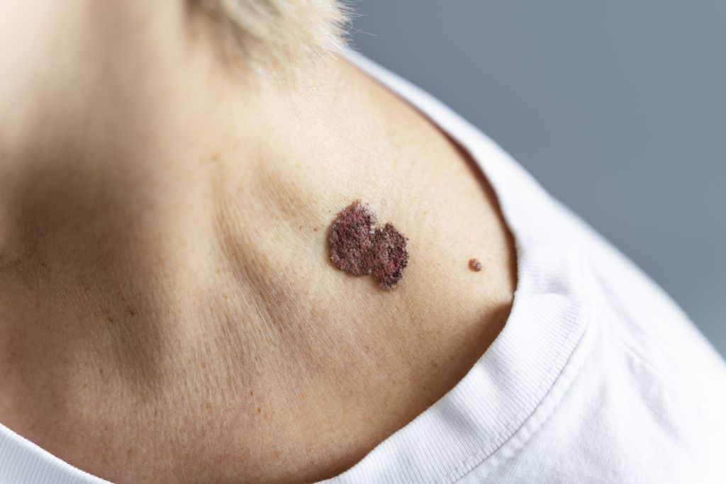 Desenvolvida pela Moderna, vacina contra o câncer de pele entra na última fase de testes clínicos (Imagem: Freepik)