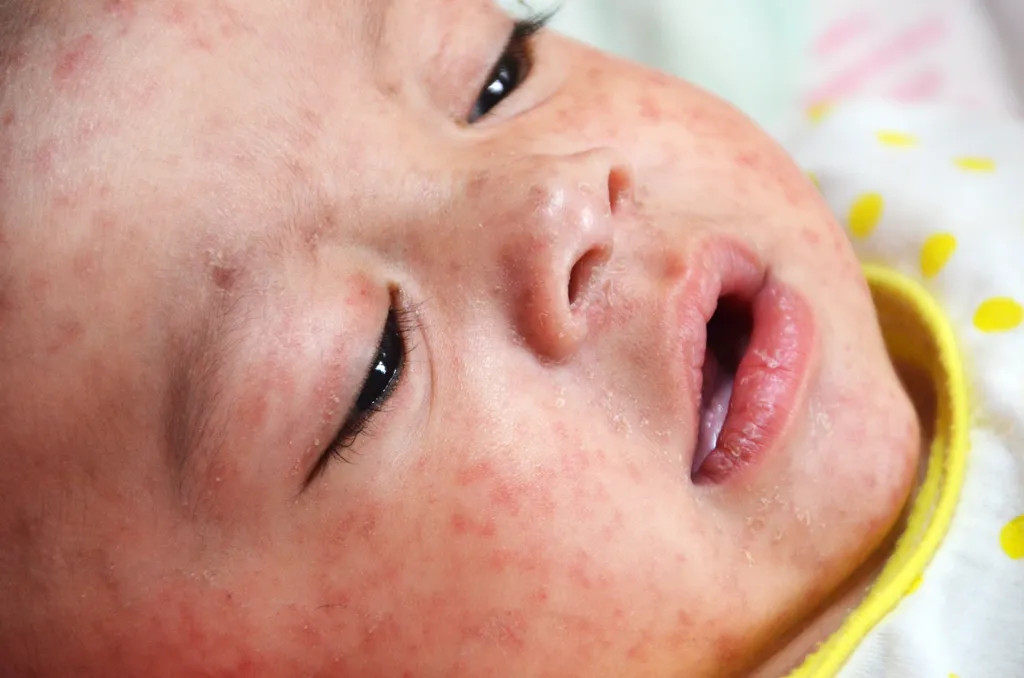 Casos de sarampo podem ser fatais em crianças e pacientes costumam apresentar manchas vermelhas no corpo (Imagem: Reprodução/CDC/James Goodson)
