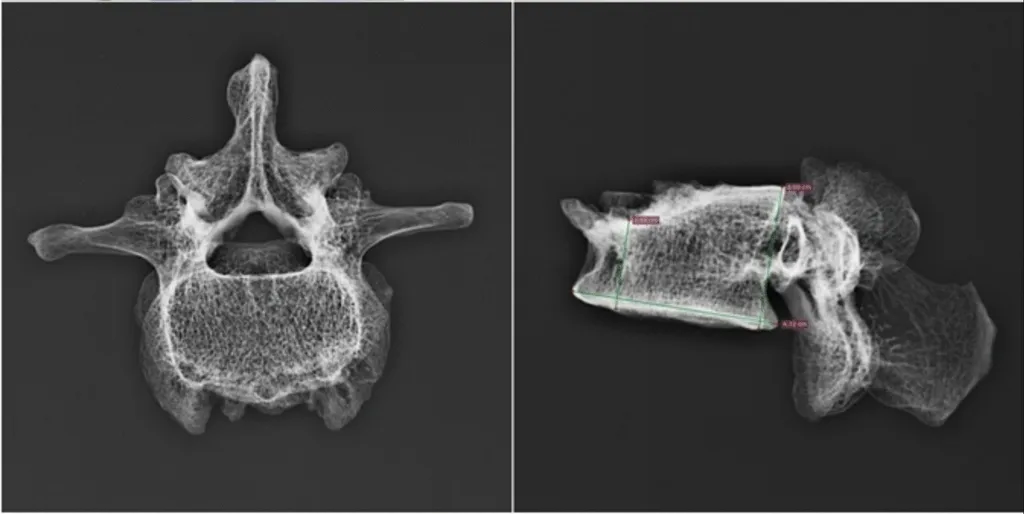 Radiografia da quarta vértebra do homem cujo genoma foi sequenciado em Pompeia (Imagem: Gabriele Scorrano et.al/Scientific Reports)