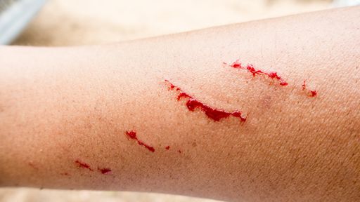 Pesquisadores usam glóbulos brancos para acelerar cicatrização de feridas