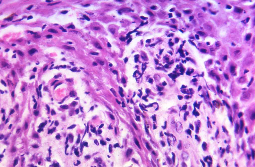 Em detalhes, uma amostra de tecido cutâneo infectado pela bactéria da sífilis (Imagem: Reprodução/CDC/Dr. Yobs)