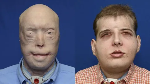 Bombeiro americano passa pelo transplante de rosto mais complexo da história