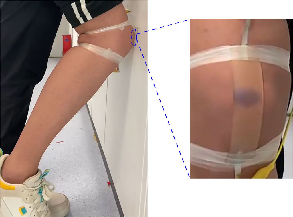 Adesivo colado no joelho de voluntários simula hematomas (Imagem: Reprodução/ACS)