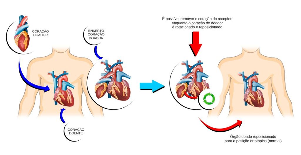 Com sucesso, InCor realiza o primeiro transplante em que o paciente vive com dois coração até a estabilização do quadro (Imagem: Divulgação/InCor)