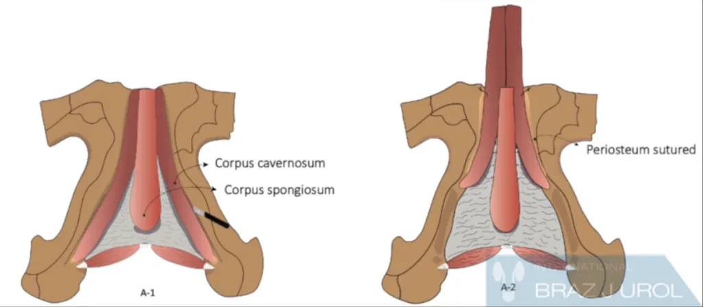O novo método utiliza os corpos cavernosos presentes no períneo para garantir o funcionamento do pênis, incluindo ereção (Imagem: Ubirajara et al./Int. Brazilian Journal of Urology)