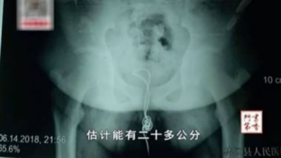 Adolescente introduz 10 cm de cabo USB no pênis e vai parar no hospital